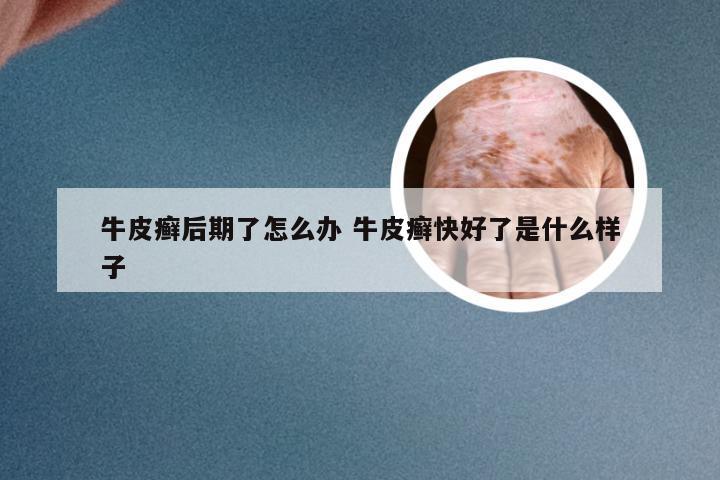 牛皮癣后期了怎么办 牛皮癣快好了是什么样子