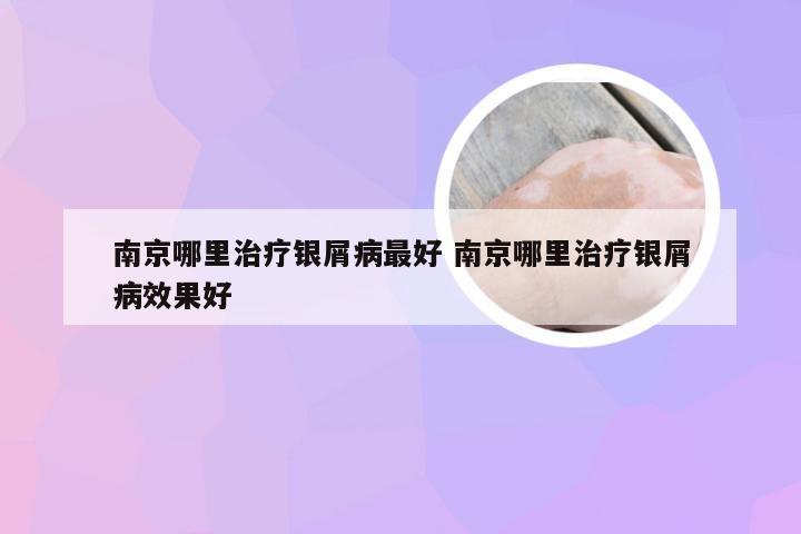南京哪里治疗银屑病最好 南京哪里治疗银屑病效果好