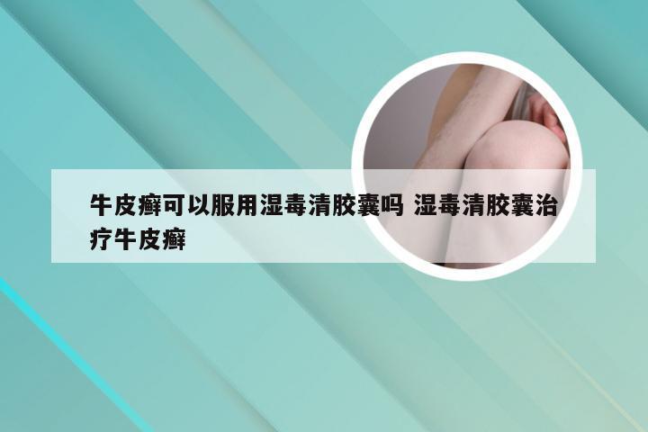 牛皮癣可以服用湿毒清胶囊吗 湿毒清胶囊治疗牛皮癣
