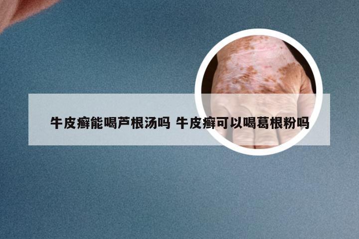 牛皮癣能喝芦根汤吗 牛皮癣可以喝葛根粉吗