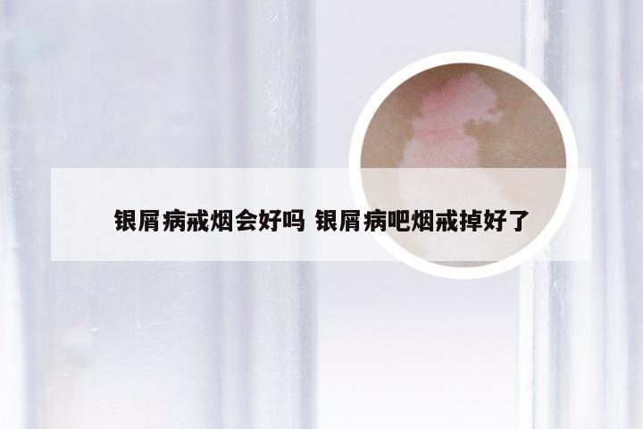 银屑病戒烟会好吗 银屑病吧烟戒掉好了