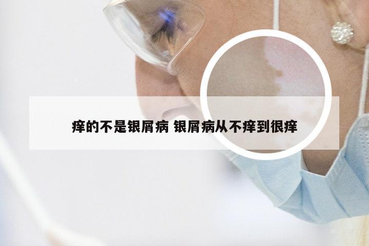 痒的不是银屑病 银屑病从不痒到很痒