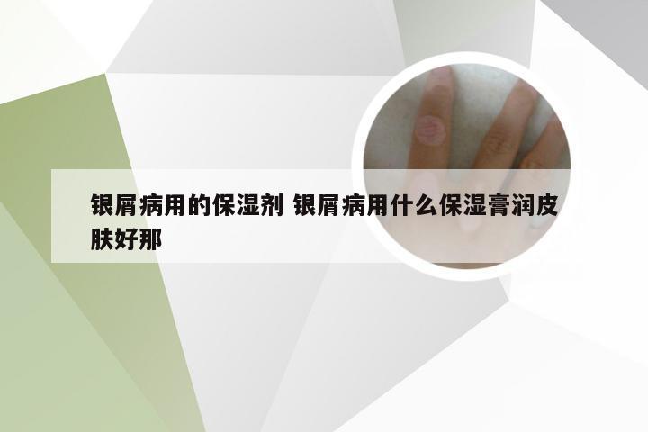 银屑病用的保湿剂 银屑病用什么保湿膏润皮肤好那