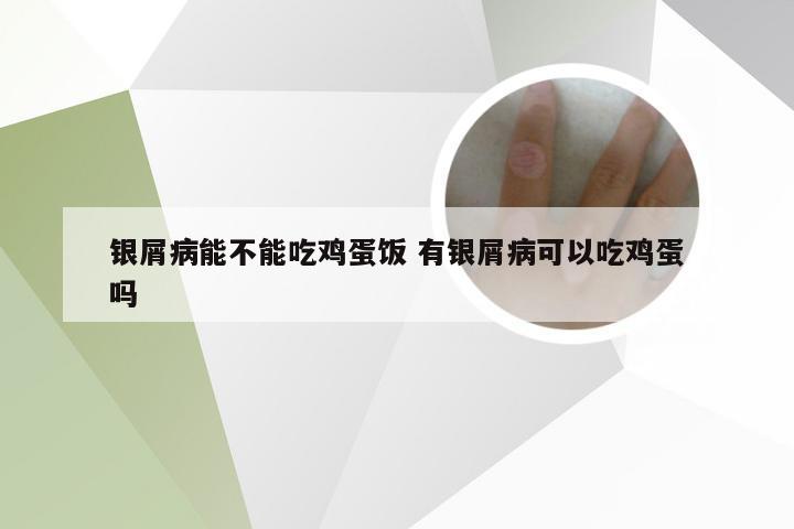 银屑病能不能吃鸡蛋饭 有银屑病可以吃鸡蛋吗