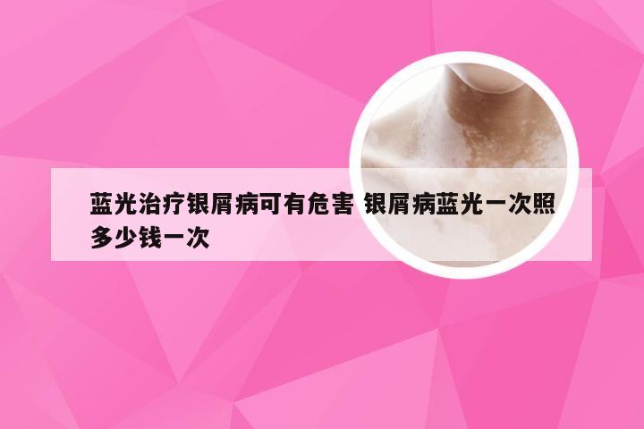 蓝光治疗银屑病可有危害 银屑病蓝光一次照多少钱一次