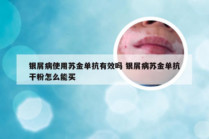 银屑病使用苏金单抗有效吗 银屑病苏金单抗干粉怎么能买