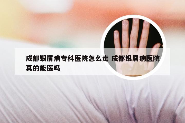 成都银屑病专科医院怎么走 成都银屑病医院真的能医吗