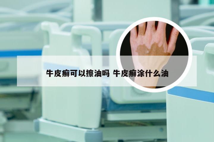牛皮癣可以擦油吗 牛皮癣涂什么油