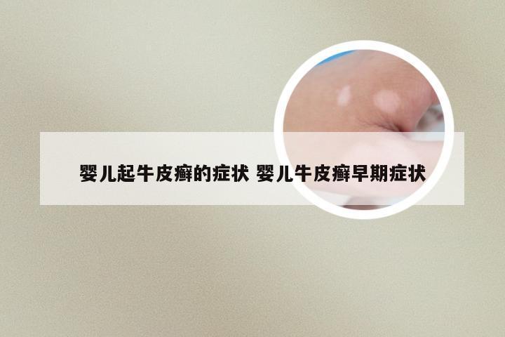婴儿起牛皮癣的症状 婴儿牛皮癣早期症状