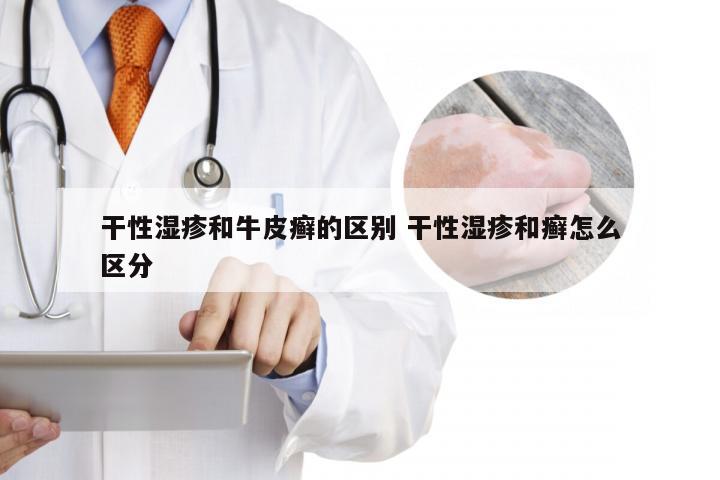 干性湿疹和牛皮癣的区别 干性湿疹和癣怎么区分