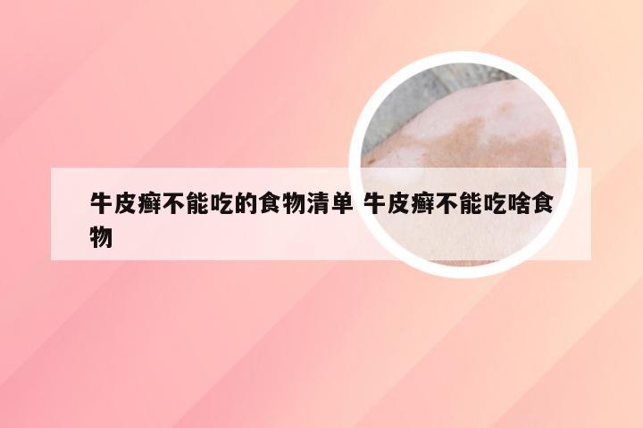 牛皮癣不能吃的食物清单 牛皮癣不能吃啥食物