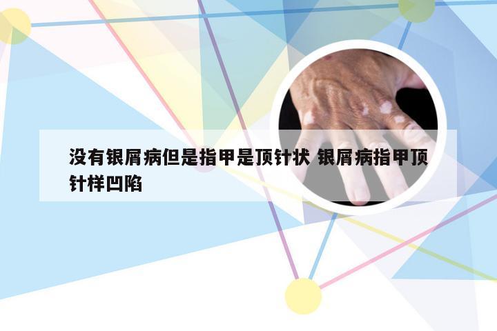 没有银屑病但是指甲是顶针状 银屑病指甲顶针样凹陷