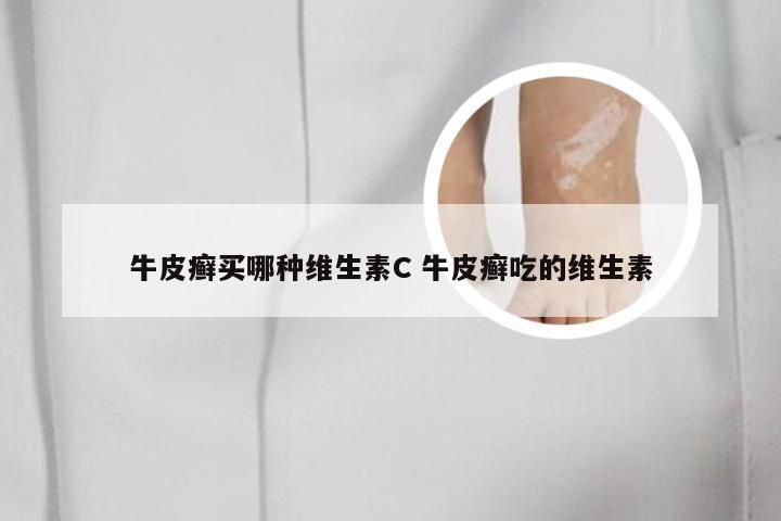 牛皮癣买哪种维生素C 牛皮癣吃的维生素