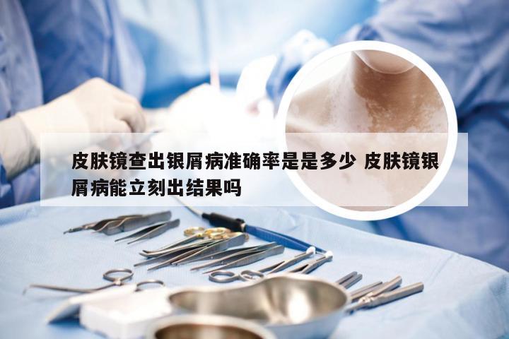 皮肤镜查出银屑病准确率是是多少 皮肤镜银屑病能立刻出结果吗