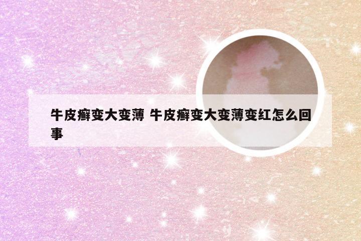 牛皮癣变大变薄 牛皮癣变大变薄变红怎么回事