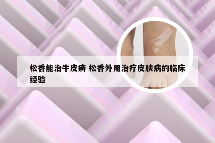 松香能治牛皮癣 松香外用治疗皮肤病的临床经验