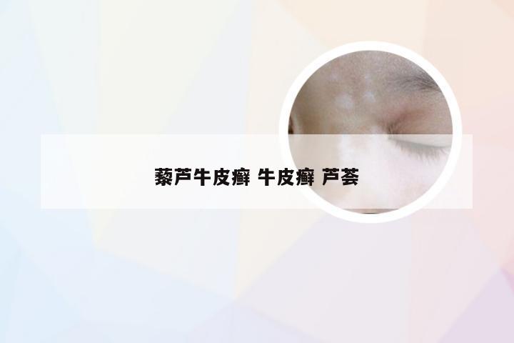 藜芦牛皮癣 牛皮癣 芦荟