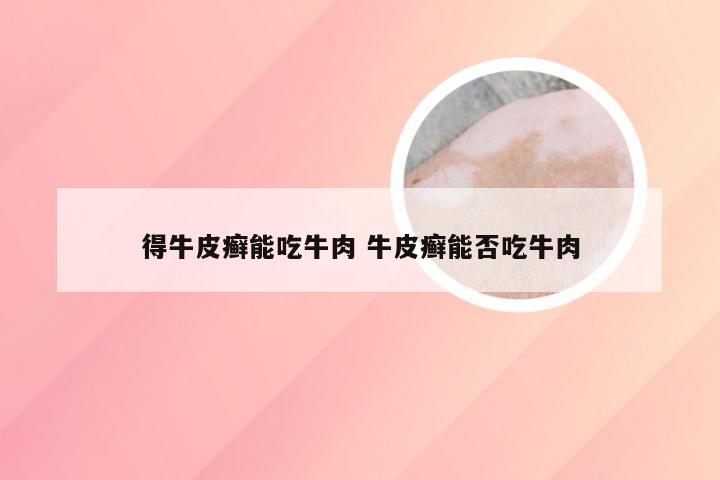 得牛皮癣能吃牛肉 牛皮癣能否吃牛肉
