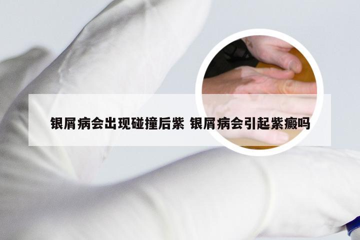 银屑病会出现碰撞后紫 银屑病会引起紫癜吗