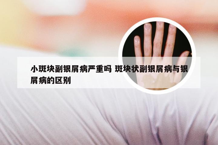 小斑块副银屑病严重吗 斑块状副银屑病与银屑病的区别
