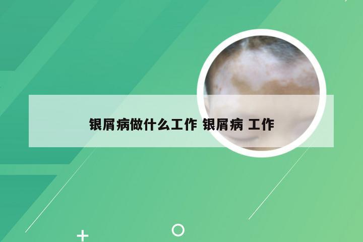 银屑病做什么工作 银屑病 工作