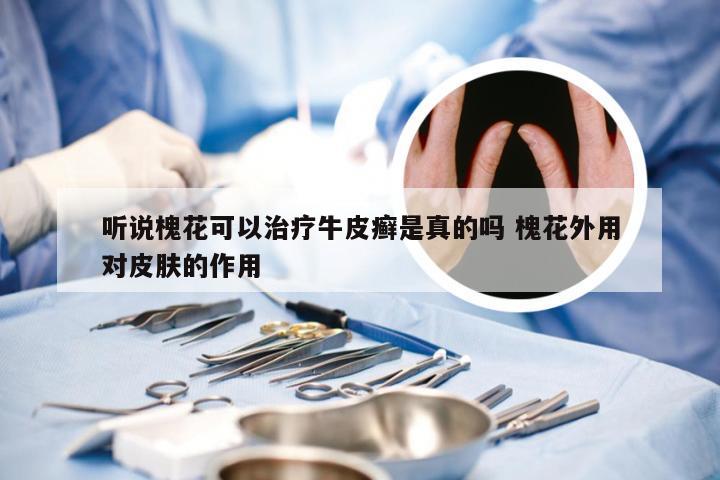 听说槐花可以治疗牛皮癣是真的吗 槐花外用对皮肤的作用