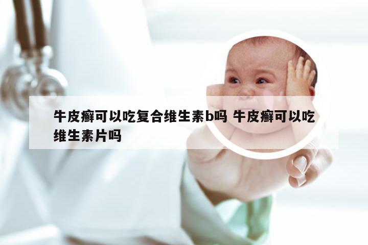 牛皮癣可以吃复合维生素b吗 牛皮癣可以吃维生素片吗