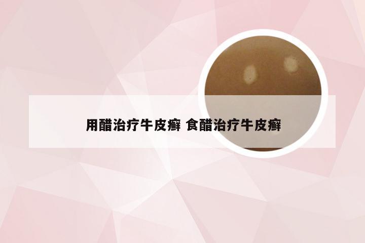 用醋治疗牛皮癣 食醋治疗牛皮癣