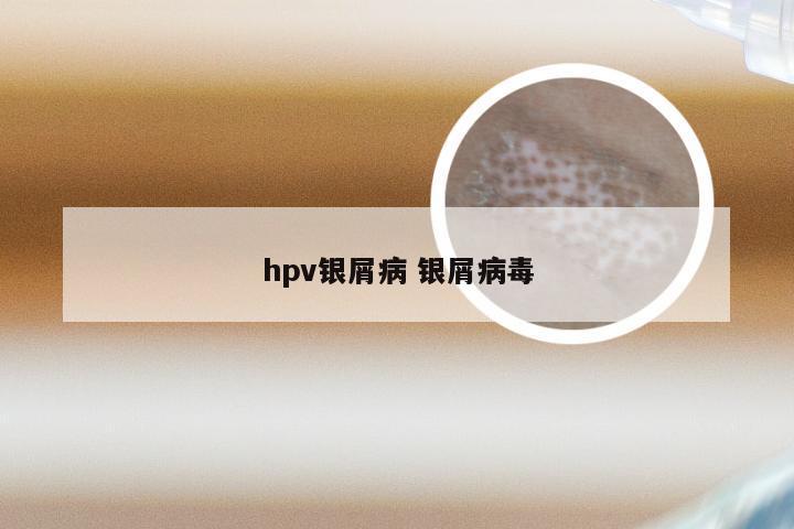 hpv银屑病 银屑病毒