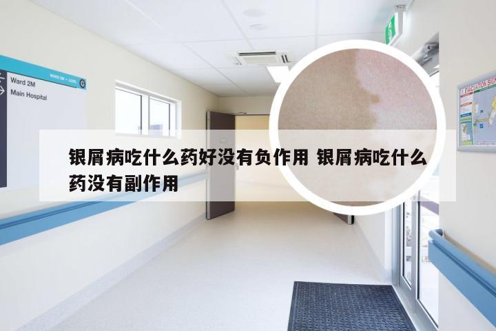 银屑病吃什么药好没有负作用 银屑病吃什么药没有副作用