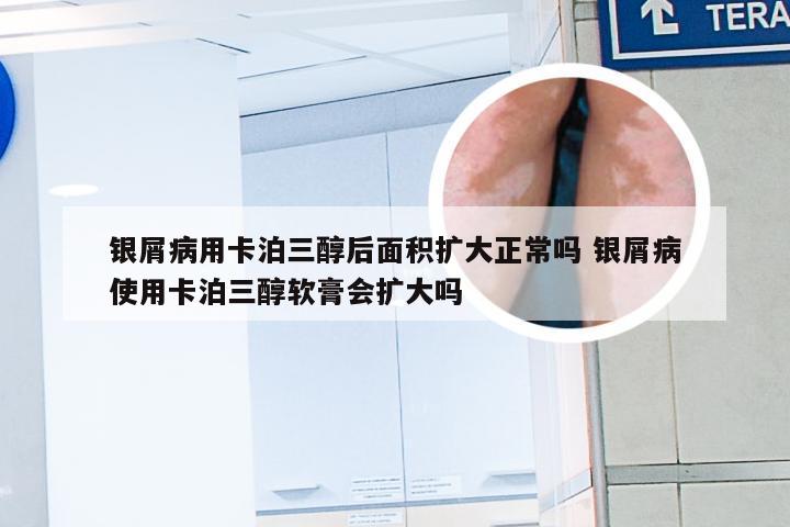 银屑病用卡泊三醇后面积扩大正常吗 银屑病使用卡泊三醇软膏会扩大吗