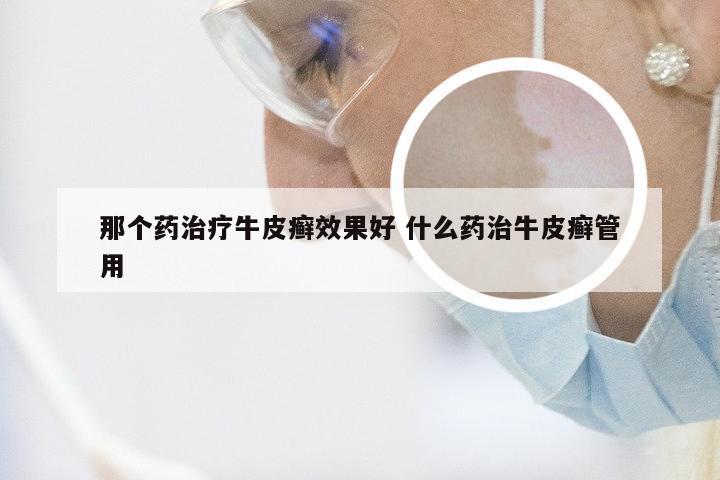 那个药治疗牛皮癣效果好 什么药治牛皮癣管用