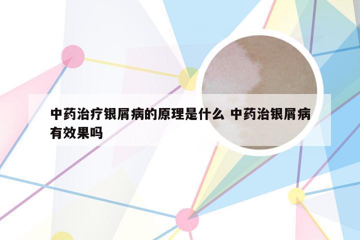 中药治疗银屑病的原理是什么 中药治银屑病有效果吗