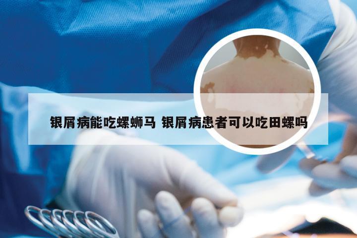 银屑病能吃螺蛳马 银屑病患者可以吃田螺吗