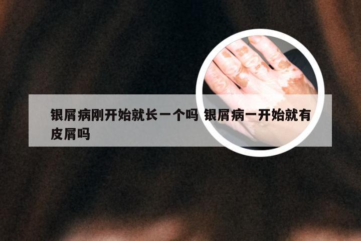 银屑病刚开始就长一个吗 银屑病一开始就有皮屑吗