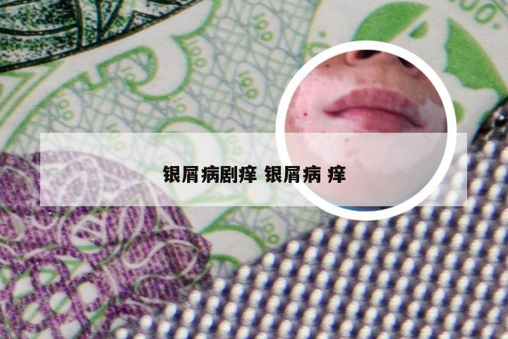 银屑病剧痒 银屑病 痒