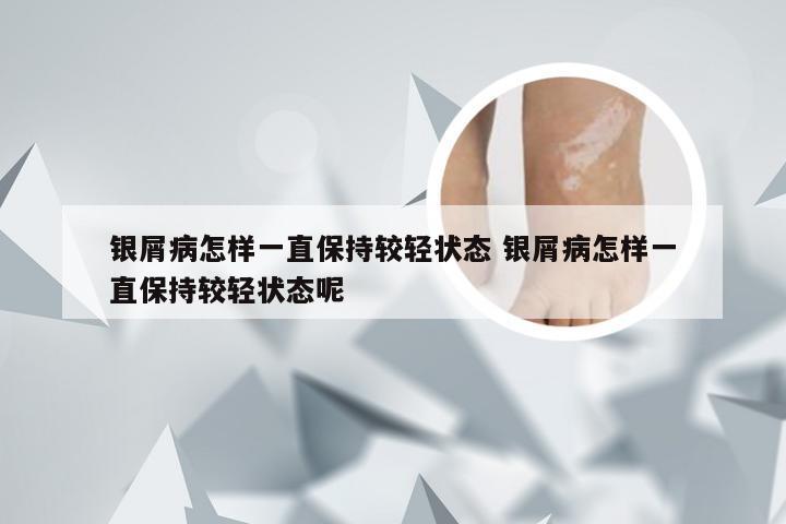 银屑病怎样一直保持较轻状态 银屑病怎样一直保持较轻状态呢