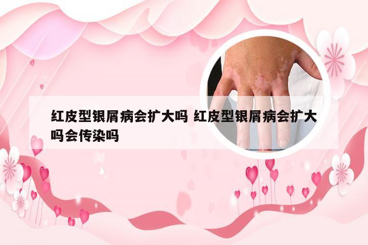 红皮型银屑病会扩大吗 红皮型银屑病会扩大吗会传染吗