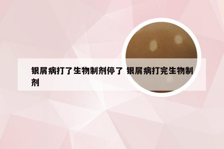 银屑病打了生物制剂停了 银屑病打完生物制剂
