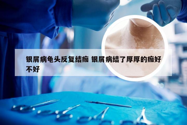 银屑病龟头反复结痂 银屑病结了厚厚的痂好不好