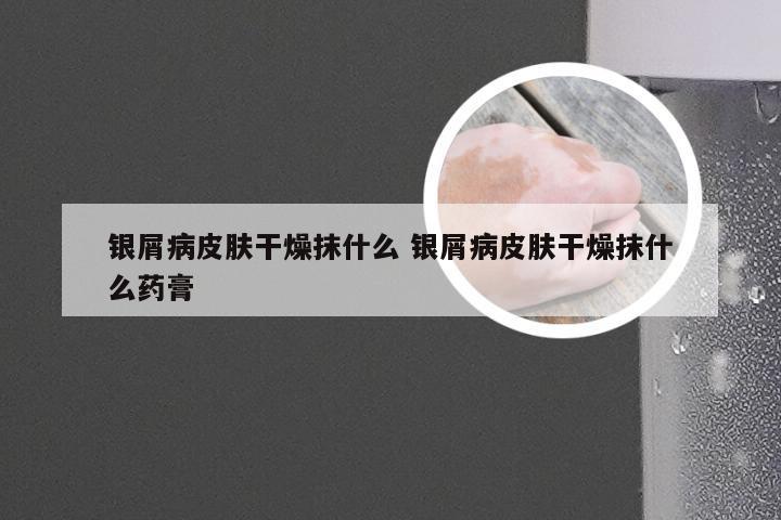银屑病皮肤干燥抹什么 银屑病皮肤干燥抹什么药膏