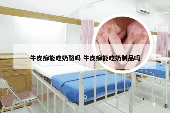 牛皮癣能吃奶酪吗 牛皮癣能吃奶制品吗