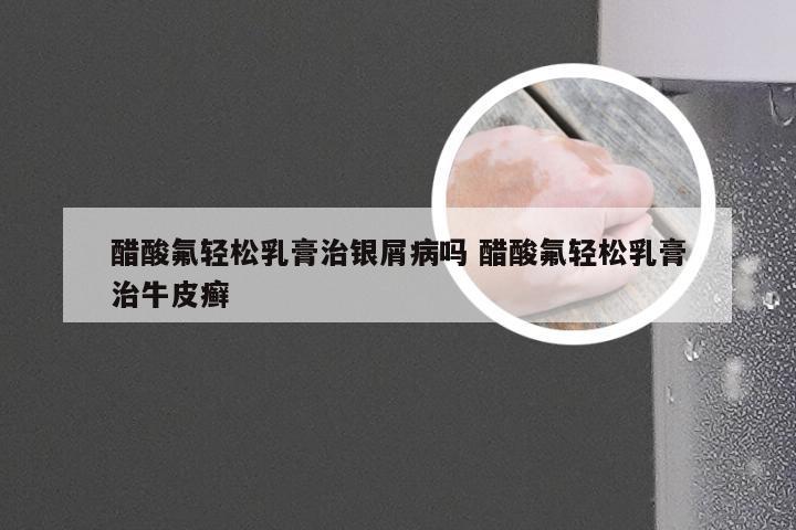 醋酸氟轻松乳膏治银屑病吗 醋酸氟轻松乳膏治牛皮癣