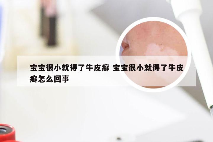 宝宝很小就得了牛皮癣 宝宝很小就得了牛皮癣怎么回事