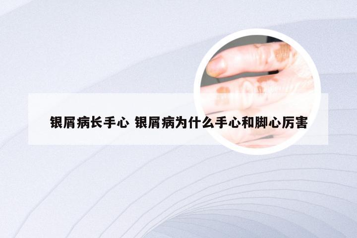 银屑病长手心 银屑病为什么手心和脚心厉害
