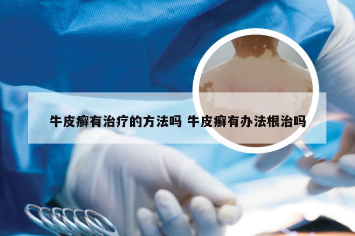 牛皮癣有治疗的方法吗 牛皮癣有办法根治吗