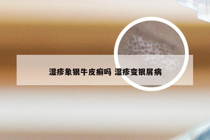 湿疹象银牛皮癣吗 湿疹变银屑病