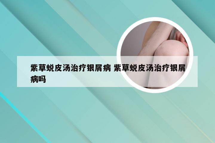 紫草蜕皮汤治疗银屑病 紫草蜕皮汤治疗银屑病吗