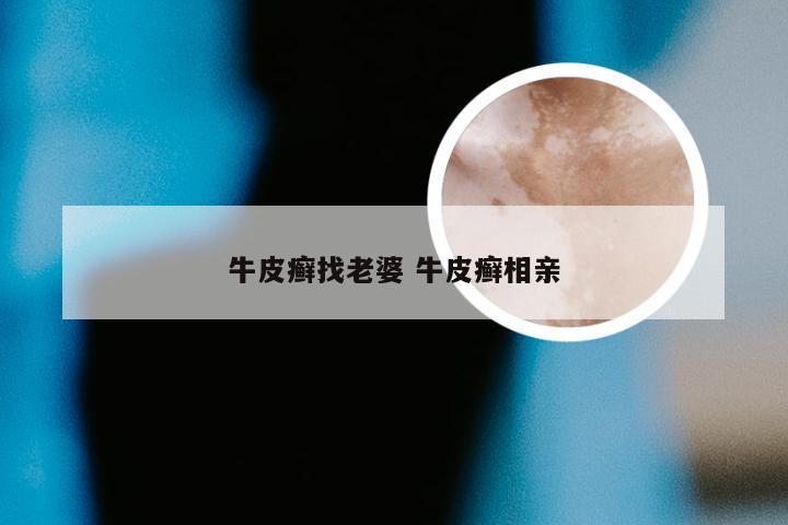牛皮癣找老婆 牛皮癣相亲