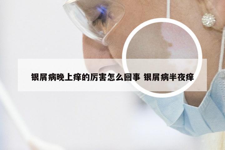 银屑病晚上痒的厉害怎么回事 银屑病半夜痒